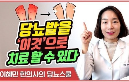 [당뇨스쿨] 당뇨발을 치료하는 새로운 시술법?